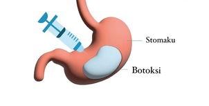 Botoksi Gastrik